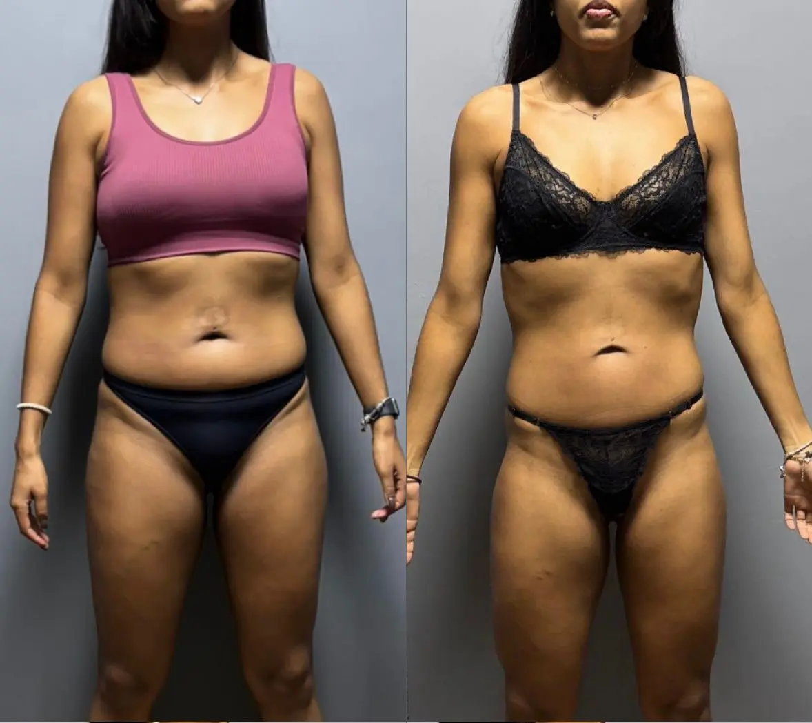 Resultado antes e depois
