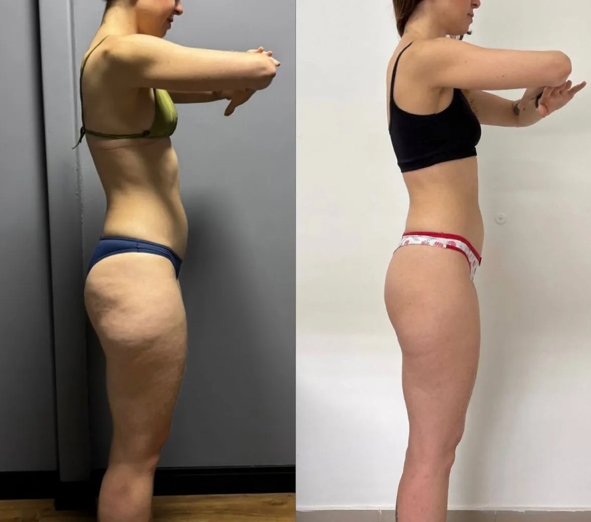 Resultado antes e depois